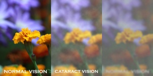 How cataracts affect vision